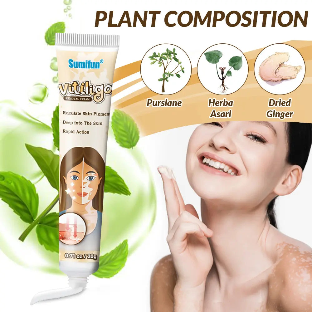 cream vitiligo
